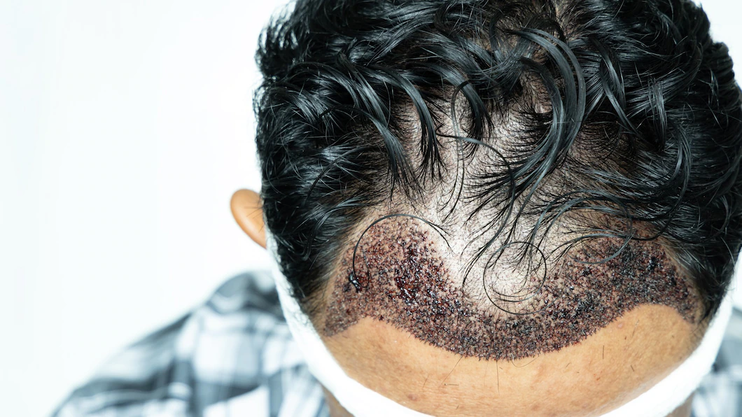 Jak długo trwa przeszczep włosów?